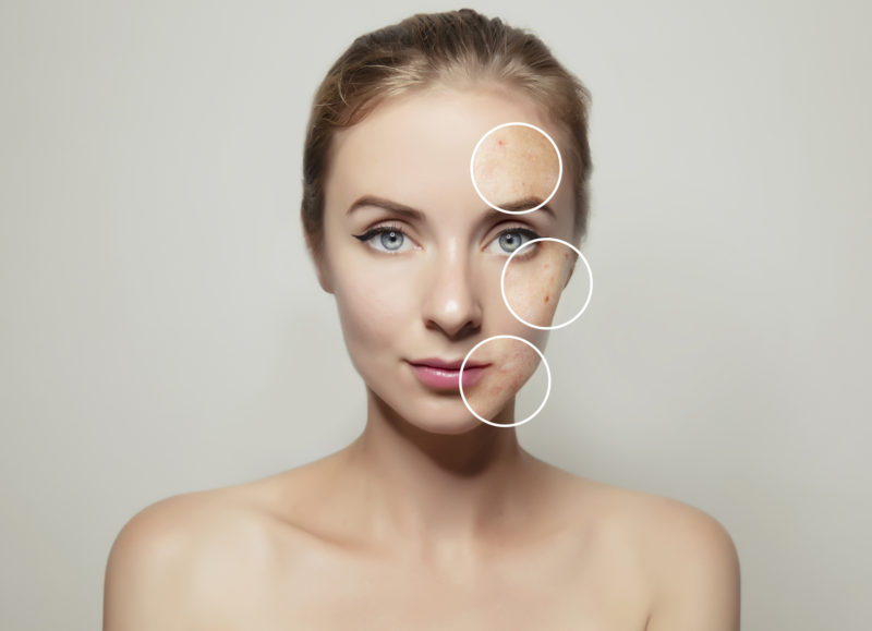 How to get rid of acne and acne quickly? Keto Skin Improvement - woman face portrait with clear and pimpled skin 1143099919 2038x1475 800x579 1 woman face portrait with clear and pimpled skin _ - How to get rid of acne and acne quickly? Keto Skin Improvement